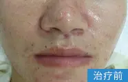 痤疮治疗前的案例图