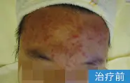痤疮治疗前的案例图