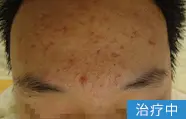 痤疮治疗中的案例图