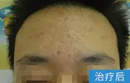 痤疮治疗后的案例图