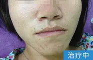 痤疮治疗中的案例图