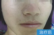 痤疮治疗后的案例图