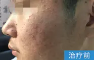 痤疮治疗前案例图