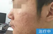 痤疮治疗中案例图