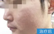 痤疮治疗后案例图