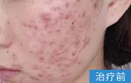 痤疮治疗前的案例图