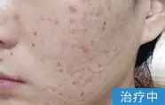 痤疮治疗中的案例图