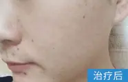 痤疮治疗后的案例图